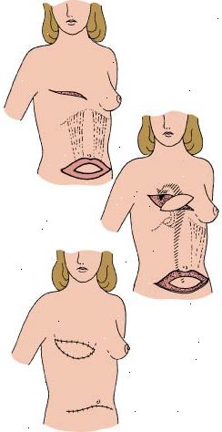 Procedimiento de colgajo Tram que muestra cómo se utiliza el tejido abdominal para reconstruir la mama eliminado