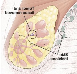 Anatomía del seno con el círculo alrededor del tumor en el conducto que muestra de tejido para ser eliminado. Hay líneas de puntos por encima del pezón y en la axila para mostrar pequeños sitios de la incisión curvas.
