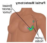 Dibujo de una mastectomía parcial
