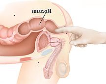 Un tacto rectal puede detectar un crecimiento en el recto o el ano.