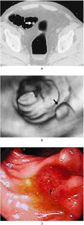 Pólipo colorrectal en el colon sigmoide visto por tomografía computarizada (A), la colonoscopia virtual (B), y la colonoscopia convencional (C).