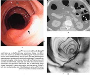 Carcinoma cecal y pólipo visto por tomografía computarizada (A), colonoscopia virtual (B), y la colonoscopia convencional (C).