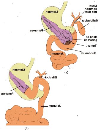 Pancreaticoduodenectomía conservación del píloro: anatomía de la zona resecada (a) y en el tracto digestivo reconectado con pancreaticoyeyunostomía de extremo a extremo (b).